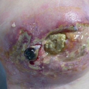 Oncologic wounds before and after treatment. View our case reports to learn more.