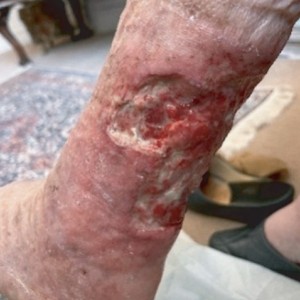 Leg ulcer before and after treatment. View our case reports to learn more.