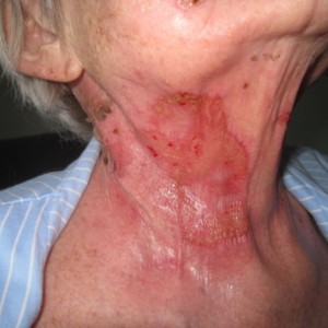 Wounds from radiotherapy before and after treatment. View our case reports to learn more.