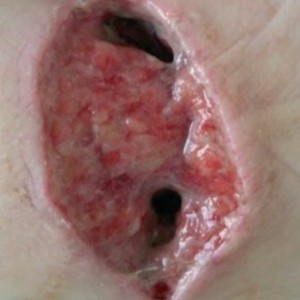 Post-surgical wounds before and after treatment. View our case reports to learn more.