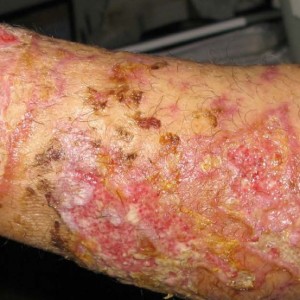 Superficial and deep partial thickness burns before and after treatment. View our case reports.