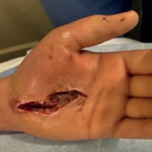 Traumatic wounds before and after treatment. View our case reports to learn more.