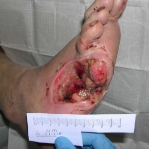Diabetic foot ulcer before and after treatment. View our case reports to learn more.